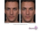 Results using the new Total Tip from Thermage﻿!